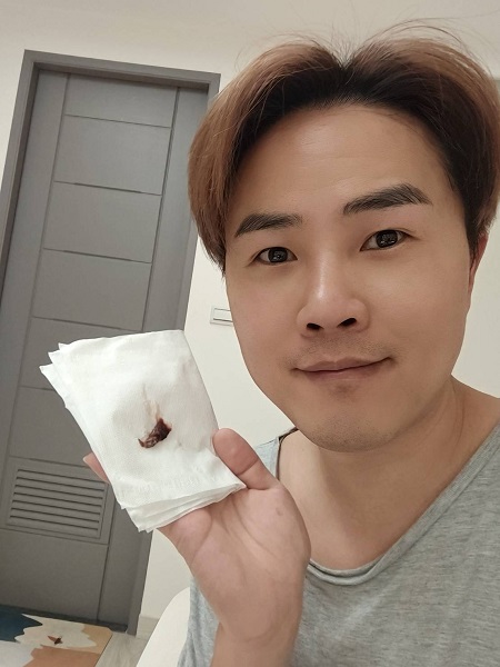 陳孟賢接受鼻炎微創手術擤出大片血塊!擺脫過敏之苦(全球巨星有限公司提供)